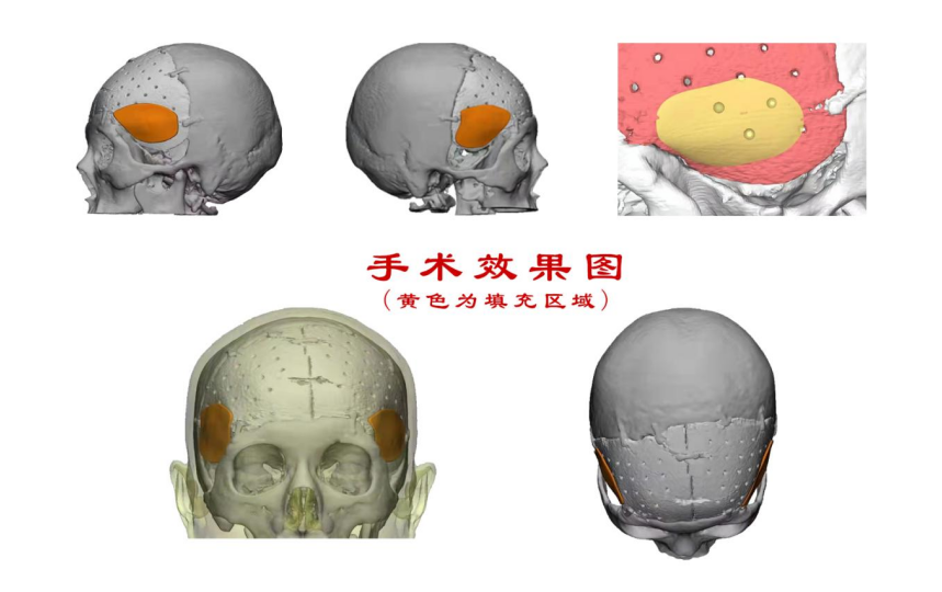 林志穎車禍致顏面骨折，醫(yī)生：或可用3D打印建模進行術(shù)后修復