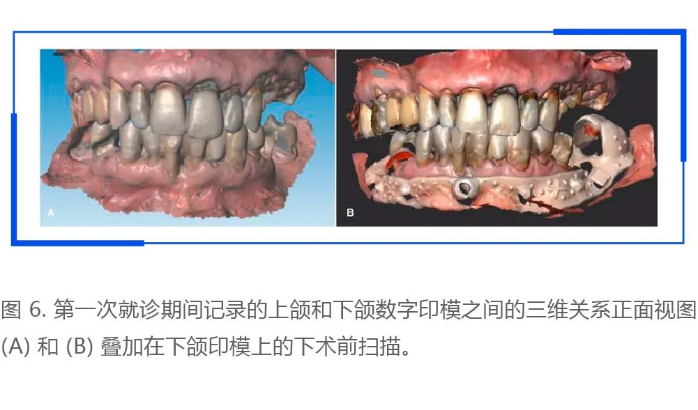 利用口腔掃描儀進行術前口內掃描和數(shù)字化設計